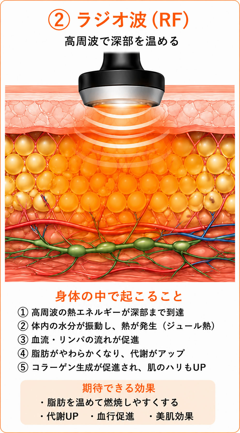 ラジオ波図解画像